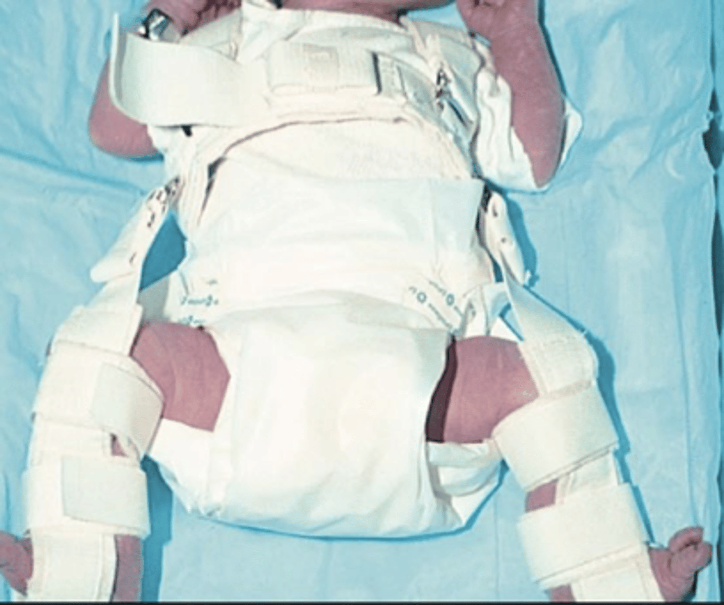 <p>Pavlik Harness is an orthopedic device used to treat developmental dysplasia of the hip (DDH) in infants.</p><p>It helps keep the baby's hips in proper alignment to promote normal joint development.</p>