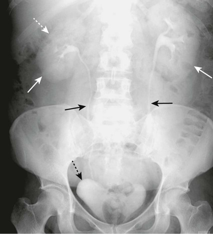 <p>-pt given IV contrast (excreted by kidneys)</p><p>-we can see kidneys, ureters, and bladder</p>