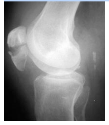 <p><span>What bone is fractured in this patient? (Image attached)</span></p>
