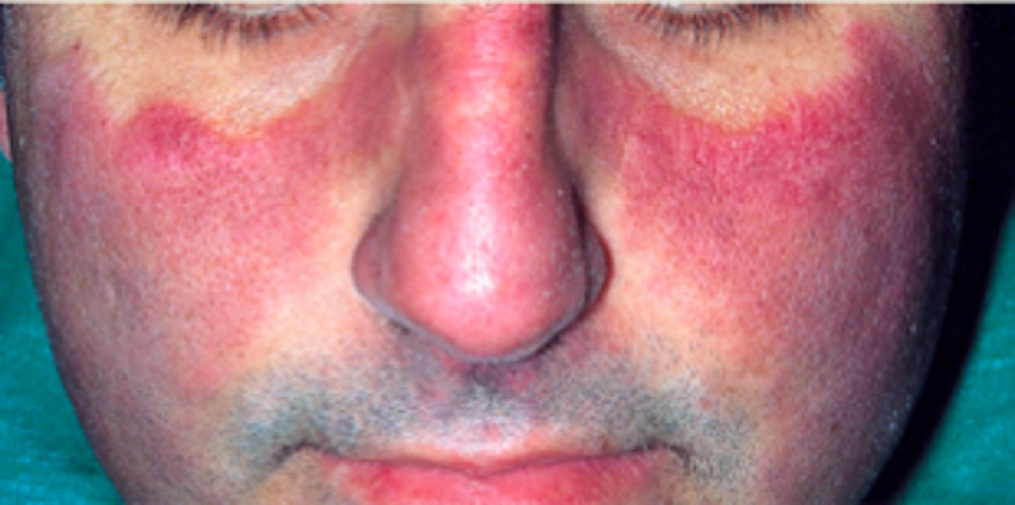 <p>Autoantibodies: classic are ANA antinuclear antibodies<br><br>immune complex: deposition causes organ damage (esp. skin, joints, kidney)<br><br>most common in females more specifically black middle aged women<br><br>genetic predisposition: HLA DR2, DR3<br><br>Most common symptoms: <br>- youngish female, butterfly rash of face, fever, pain and swelling in joints, chest pain, and photosensitivity<br><br>as immune complexes build up, damage can manifest as nephritis, skin lesions, arthritis<br>- there can also be hematologic and neurologic problems<br>- prone to infection<br>- may have flares and remission<br>- death usually caused by renal failure, heart problems or infections</p>