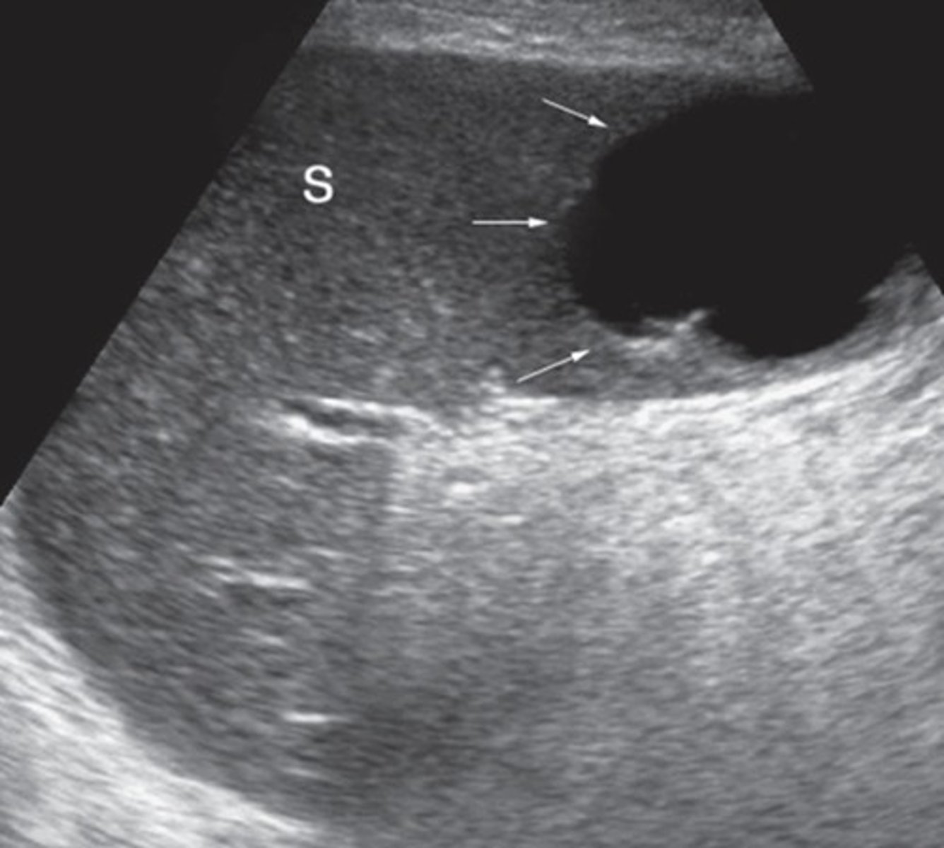 <p>Anechoic</p><p>Well-defined</p><p>Posterior enhancement</p><p>Singular or multiple</p><p>Simple or localated</p>