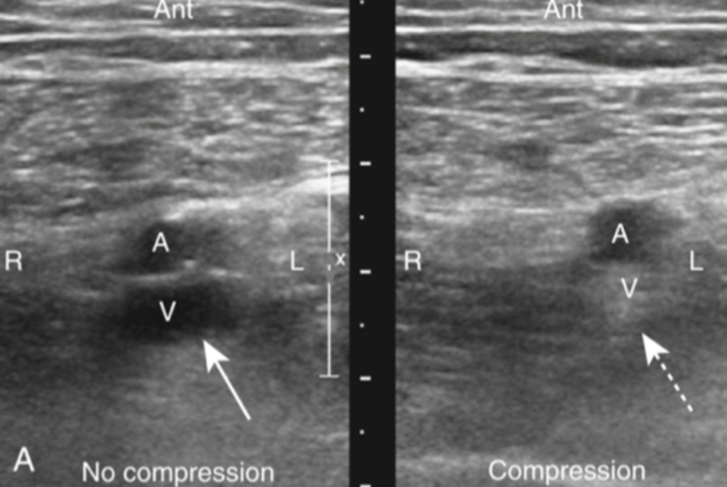 <p>how can ultrasound help diagnose DVT/PE</p>