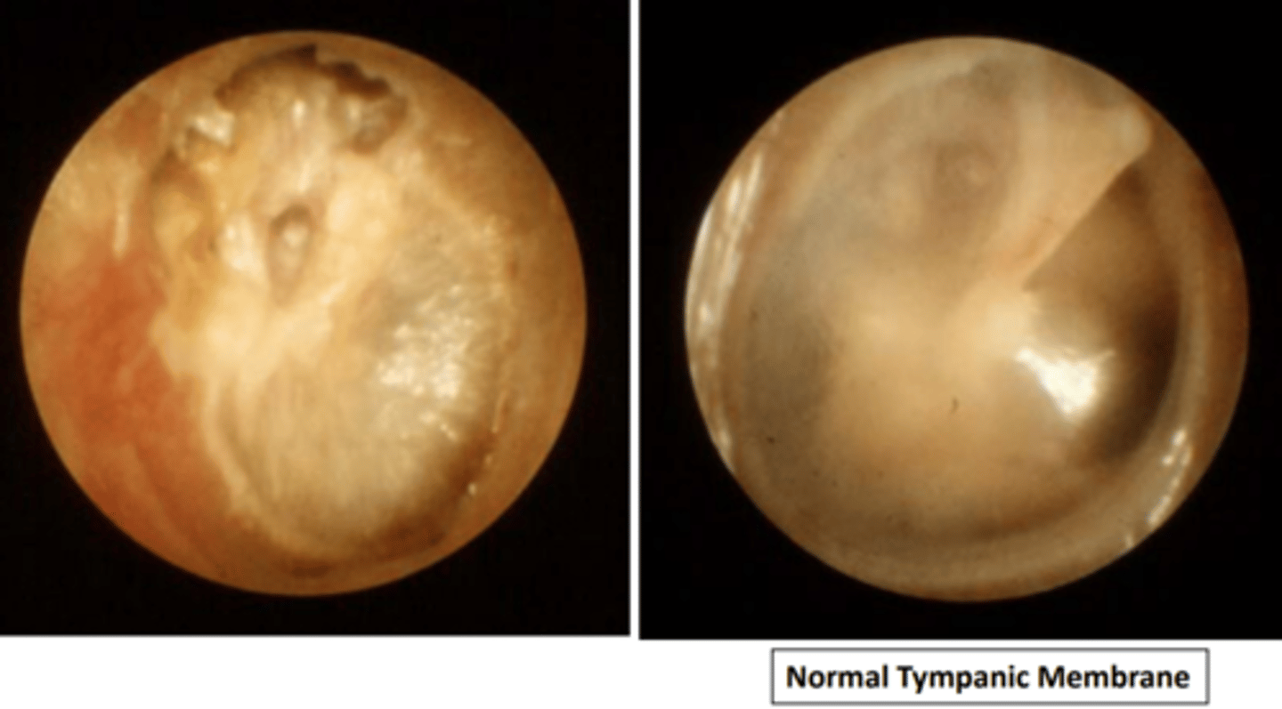 <p>• Most cholesteatomas are due to repeated middle ear infections</p><p>• Some are congenital epidermoid cysts - skin growing in the wrong place</p>