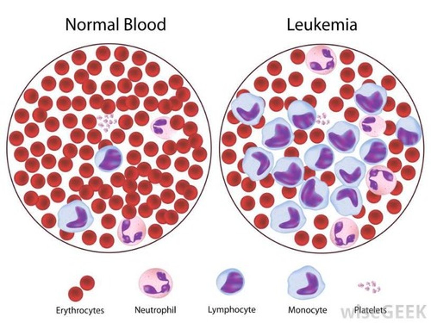 <p>many abnormal & immature leukocytes due to cancer of bone marrow</p>