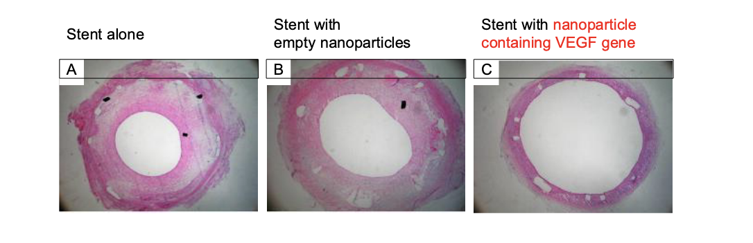<ul><li><p>stent coated with PLGA-nanoparticles containing vascular endothelial growth factor (<strong>VEGF</strong>) gene in <strong>animal</strong> model system</p><ul><li><p>keeps artery OPEN</p></li></ul></li><li><p>other potential genes to treat restenosis</p><ul><li><p><strong>PCNA</strong> (proliferating cell nuclear antigen)</p></li><li><p><strong>NOS</strong> (nitric oxide synthase)</p></li></ul></li></ul><p></p>