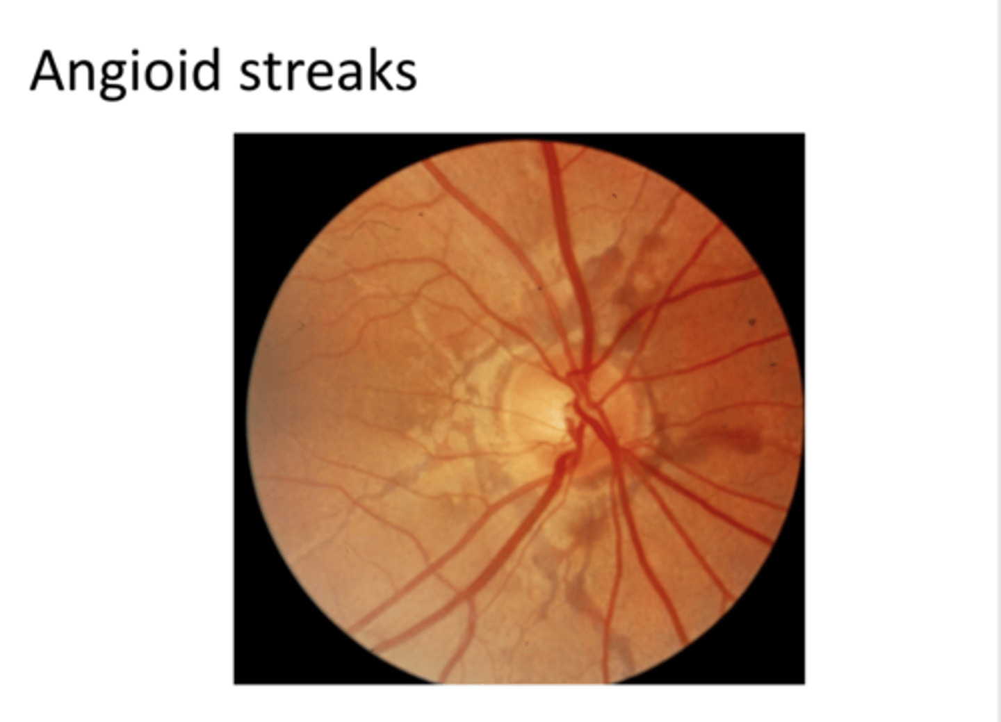 <p>Breaks in Bruch's can result in what?</p>