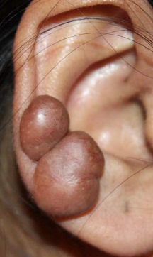 <p>Secondary Skin Lesion</p>