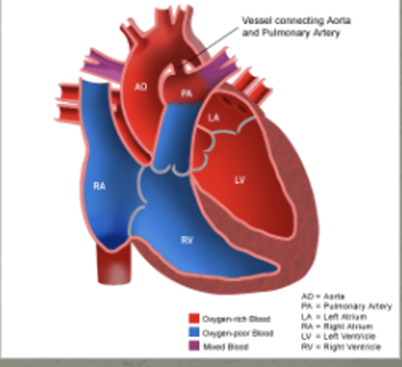 <p>patent ductus arteriosus</p>