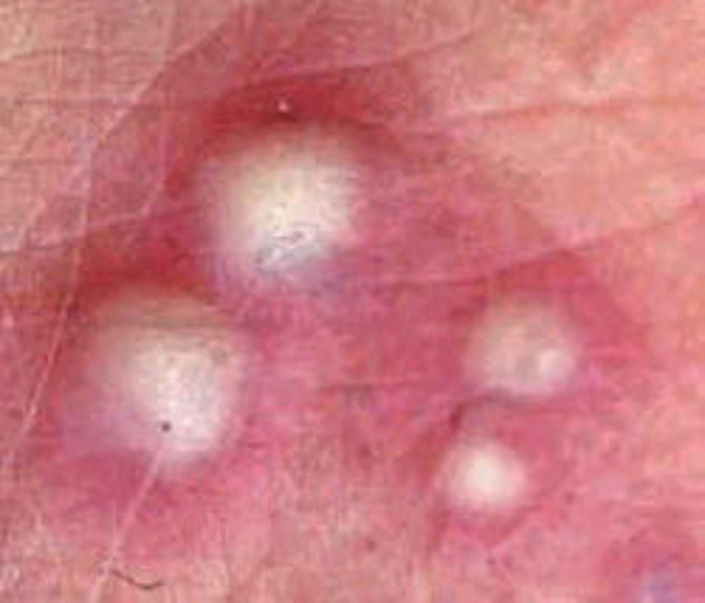 <p>circumscribed, elevated, turbid fluid filled (pus)</p>