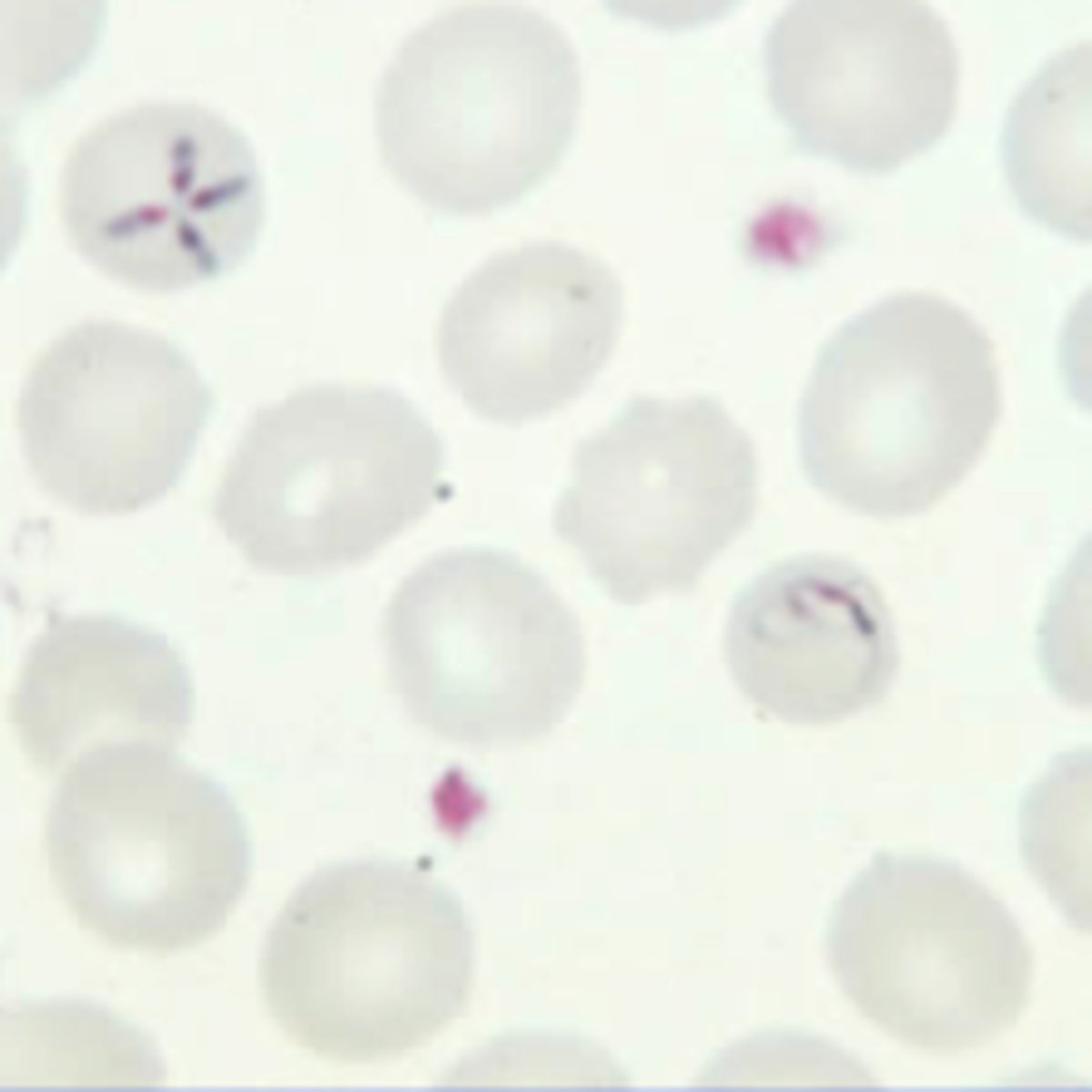 <p>Babesiosis</p><p>- Ixodes tick</p><p>- hemolytic anemias: jaundice, hemoglobinuria, renal failure, death</p><p>- Giemsa stain</p><p>- Tx: Quinine-clindamycin and Atovaquone-azithromycin</p>