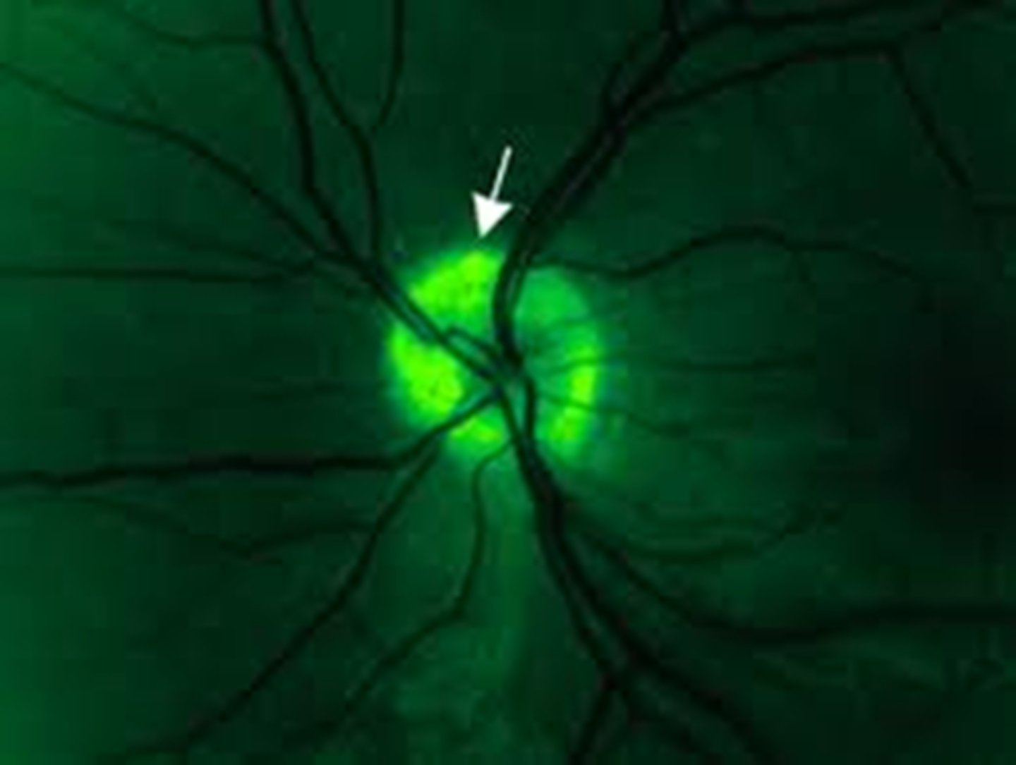 <p>retroilluminate the ONH by putting the beam right beside it</p><p>red-free filter</p>