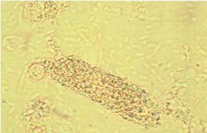 <p>What do bacteria casts contain?</p><p>what does it indicate?</p>