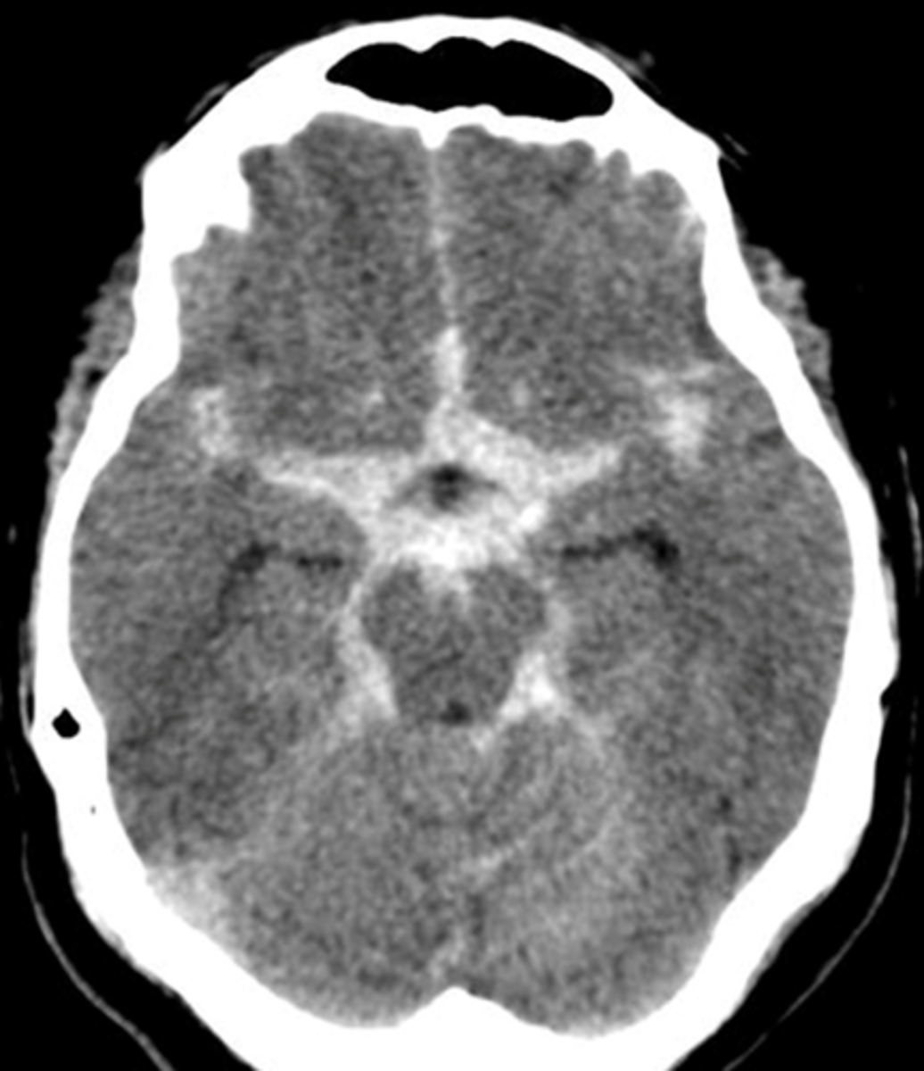 <p>bleeding appears to follow the sulci of the brain</p>