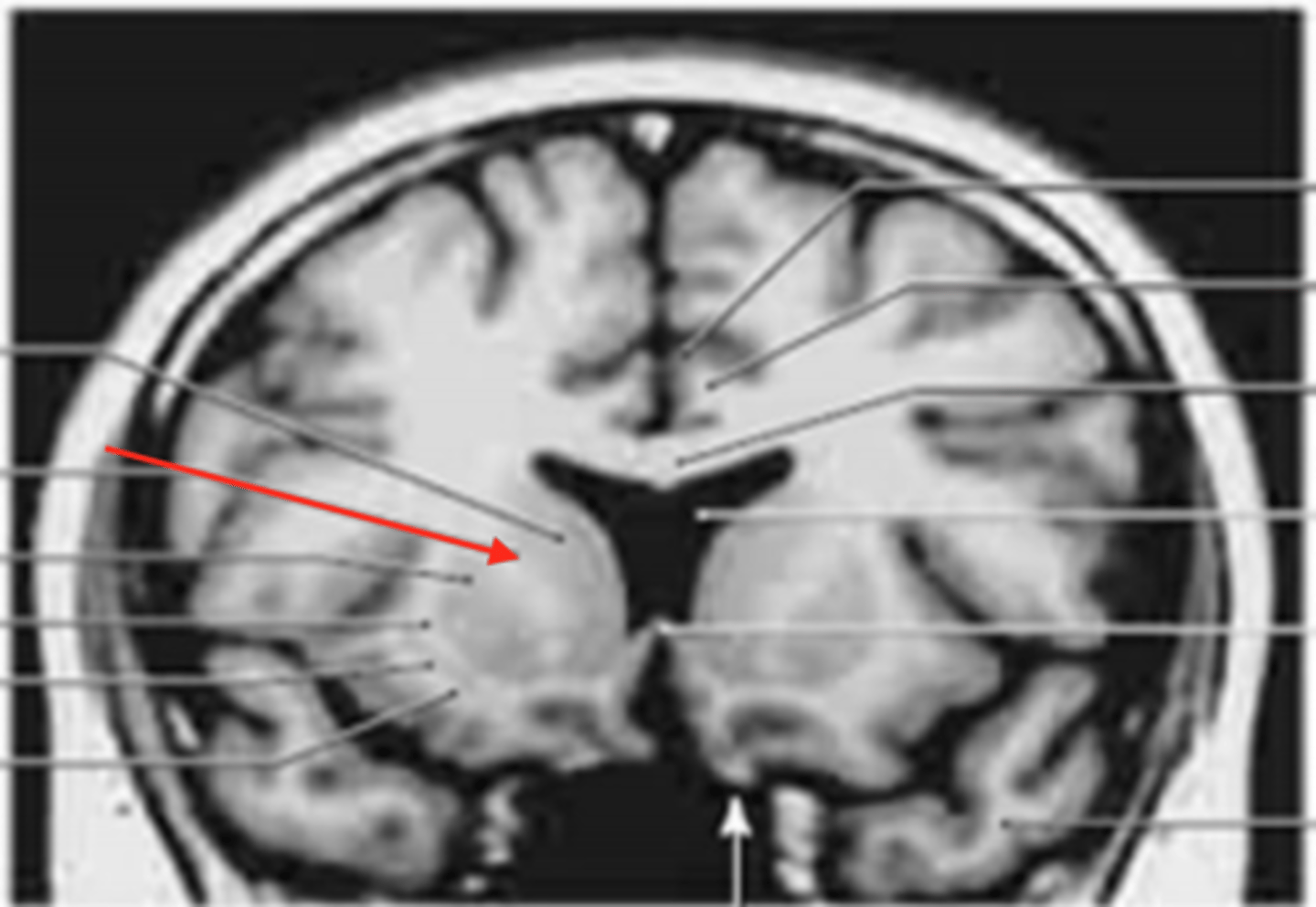 <p>Left side paralysis (or severe weakness) of the lower face</p>