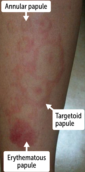 <p>mucosal involvement</p><p>EM major will have <strong>cutaneous disease with severe mucosal involvement</strong></p><p>EM minor will refer to <strong>cutaneous disease with mild or no mucosal involvement</strong></p><ul><li><p>Cutaneous lesions will <strong>manifest symmetrically on dorsal surface </strong>and then will <strong>spread toward the trunk</strong></p></li></ul><p></p>