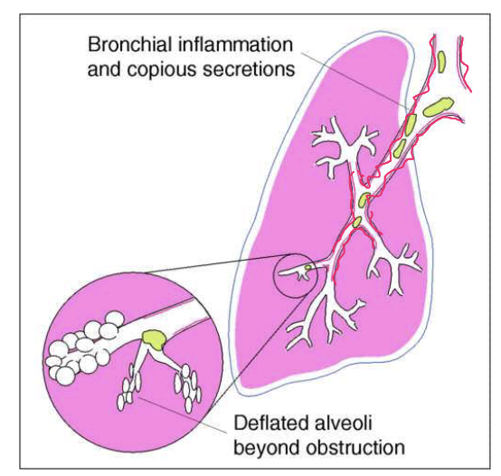 <p>inflammation of the bronchi (usually chronically), causing mucous build up </p><ul><li><p>trachea = midline </p></li><li><p>tactile fremitus = normal </p></li><li><p>percussion = resonant </p></li><li><p>breath sounds = vesicular except perhaps over large bronchi or trachea </p></li><li><p>Adventitious sounds = non OR course crackles and/or sonorous wheezes (rhonchi) </p></li></ul><p></p>