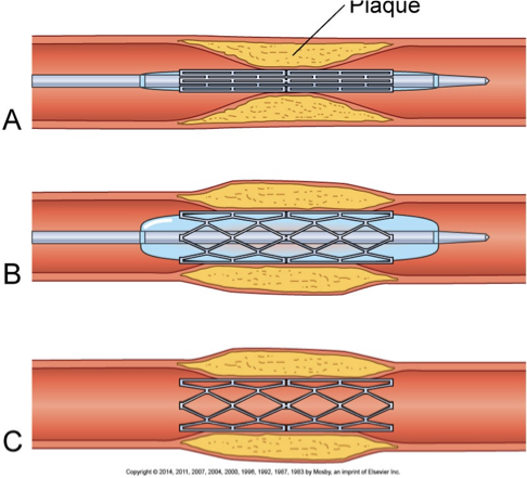 <p>Cardiac catheterization - “gold standard” to identify and localize CAD</p><ul><li><p>Visualize blockages (diagnostic)</p></li><li><p>Open blockages (interventional)</p></li><li><p>Percutaneous coronary intervention (PCI)</p></li><li><p>Balloon angioplasty</p></li></ul><p></p>