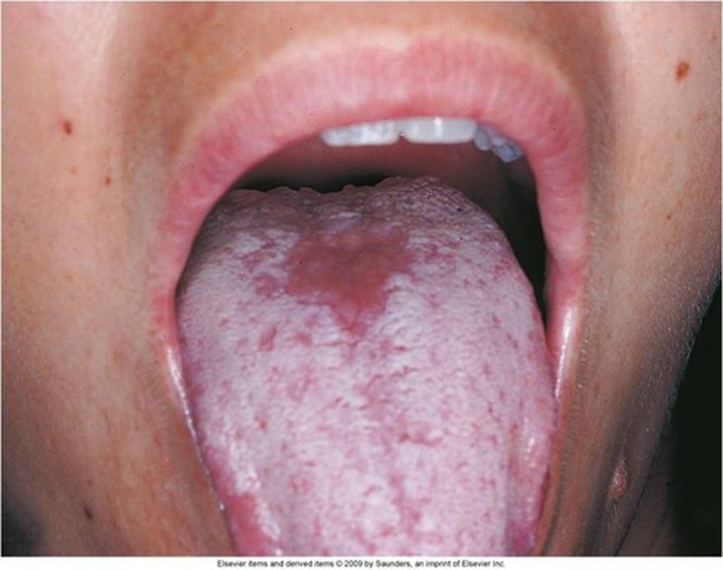 <p>candida</p><p>nystatin</p>