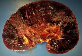 <p><strong>Chronic Rejection</strong></p><p class="MsoNormal"><strong>Front:</strong> What is chronic rejection?</p>