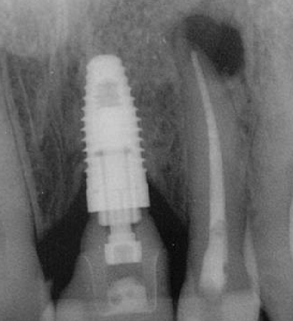 <p>periapical fibrous scar formation </p>