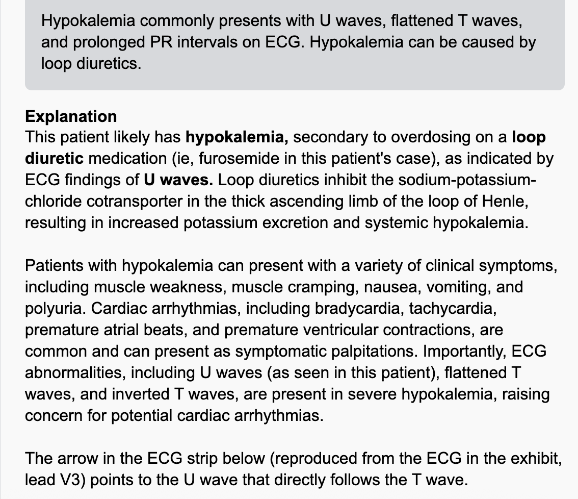 <p>Hypokalemia of ECG</p>