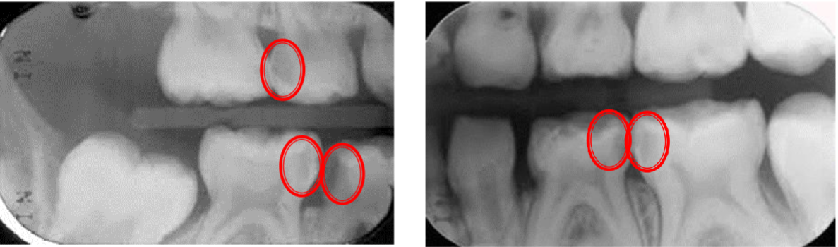 <p>patient 6 yrs ? = 6 not fully erupted </p><p>if theres a cavity on distal of D = do radiographs as might find cavity in mesial of E</p>
