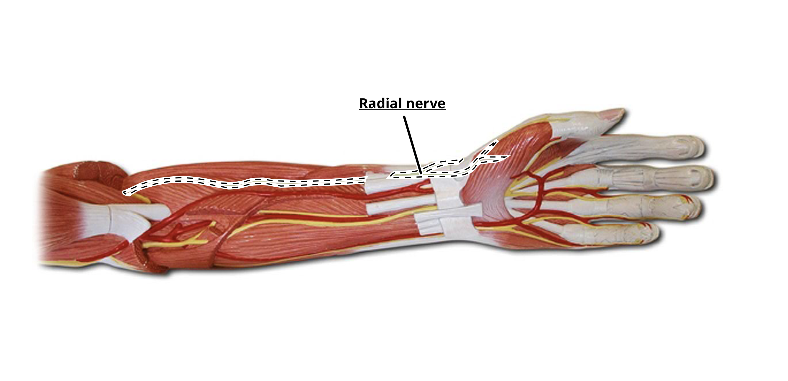 <p>Radial Nerve </p>