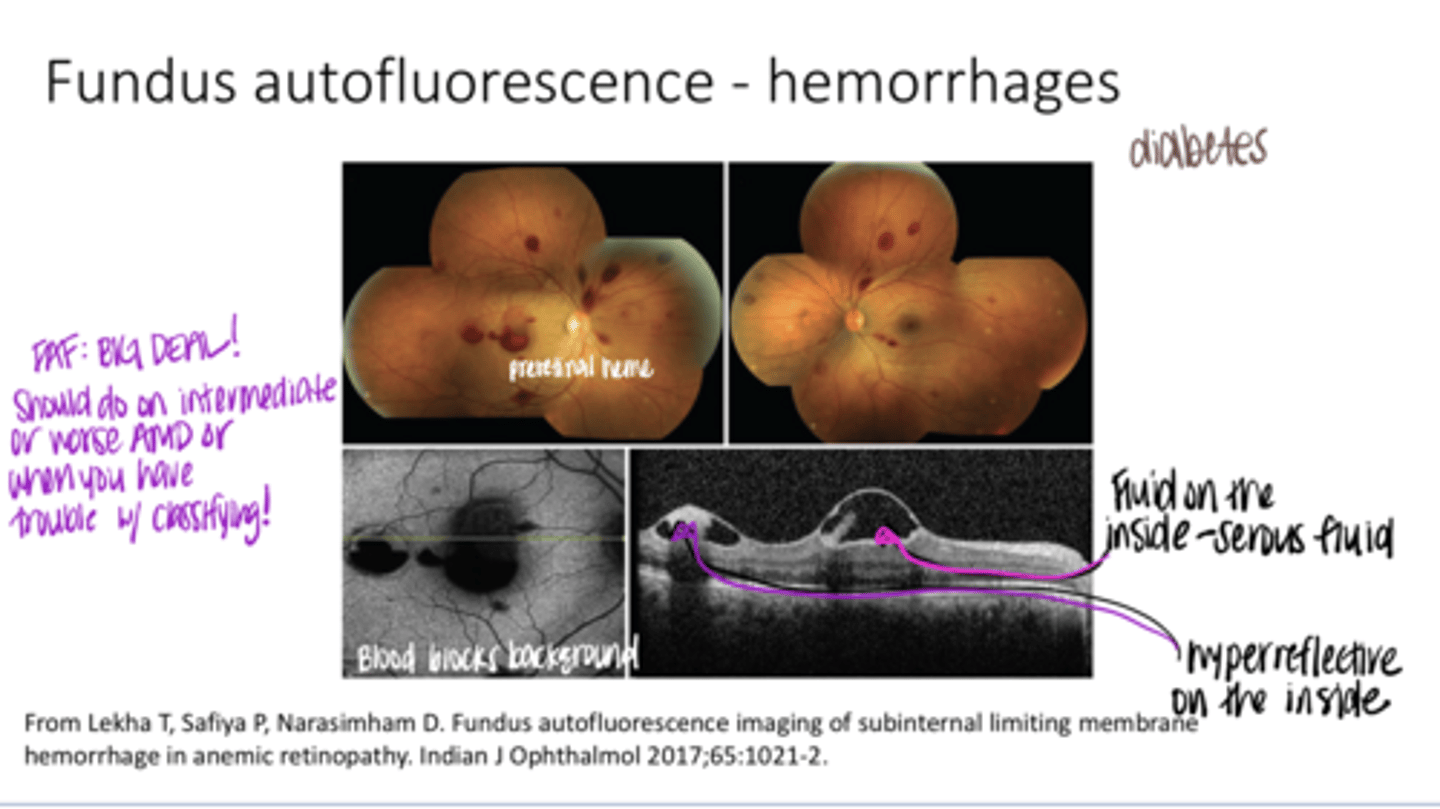 <p>Auto-Fluorescence -- Hemorrhaging (Pic)</p>