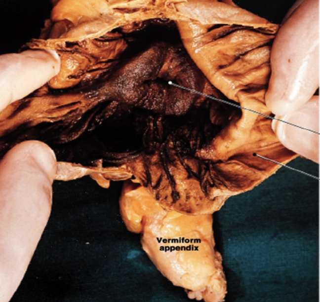 <ul><li><p>dilated pouch at junction of small &amp; large intestines (projects off appendix)</p></li><li><p>lower right quadrant</p></li><li><p>ileocecal valve guards opening</p></li></ul><p></p>