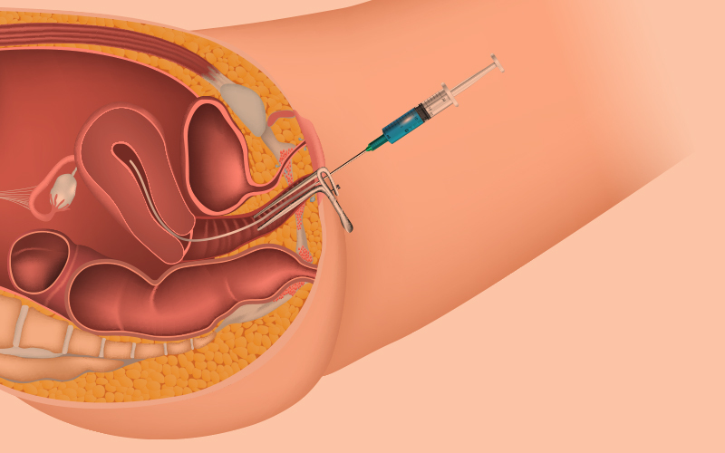 <ul><li><p> frozen </p></li><li><p>uterus. </p></li><li><p>Hint: Intra means <strong>inside.</strong> </p></li><li><p>Hint: Insemination = putting male sperm into woman or female animal through sexual activity or other methods) </p></li></ul>