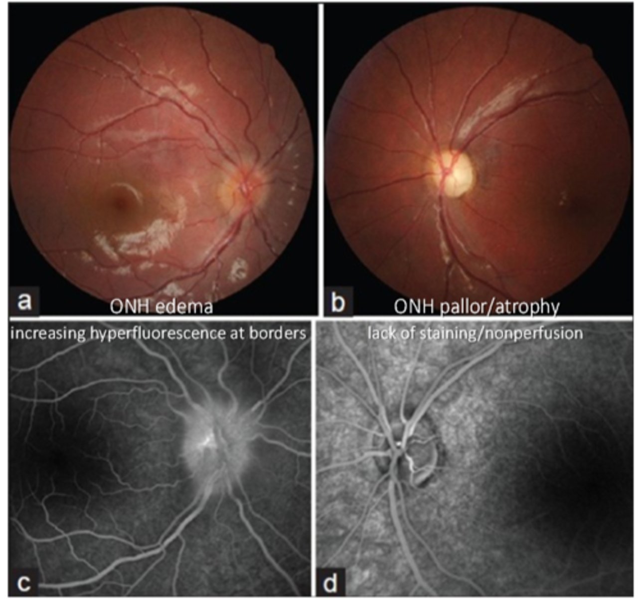 <p>neovasc (breakdown of BRB = leakage)</p><p>disc edema</p><p>vascular malformations (aneurysms, arteriolar-venous shunts, telangiectatic vessels)</p>