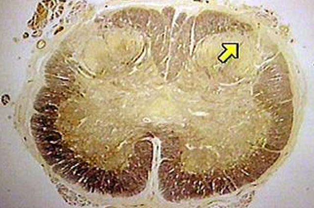 <p>ventral horn, substantia gelatinosa, clarke’s column, or dorsal root ganglion</p>