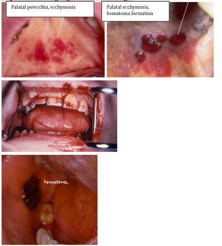 <p><span style="background-color: transparent; font-family: "Times New Roman", serif;">*<strong>Increased bleeding</strong>, even with minor trauma</span></p><p><span style="background-color: transparent; font-family: "Times New Roman", serif;">*Platelets <10,000/mm3 → risk of GI, GU, pulmonary, intracranial hemorrhage</span></p><p></p><p><span style="background-color: transparent; font-family: "Times New Roman", serif;"><u>ORAL</u>:</span></p><p><span style="background-color: transparent; font-family: "Times New Roman", serif;"><strong>*Bleeding of oral mucosa, even with minor trauma</strong></span></p><p><span style="background-color: transparent; font-family: "Times New Roman", serif;"><strong>*Spontaneous gingival hemorrhage</strong></span></p>