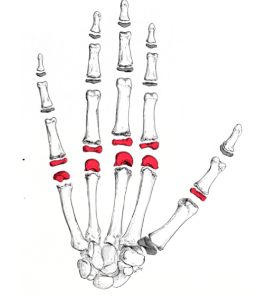 <p>What kind of <strong>Synovial Joint </strong>is the Metacarpophalangeal Joint (MCP) “knuckle joint”?</p>