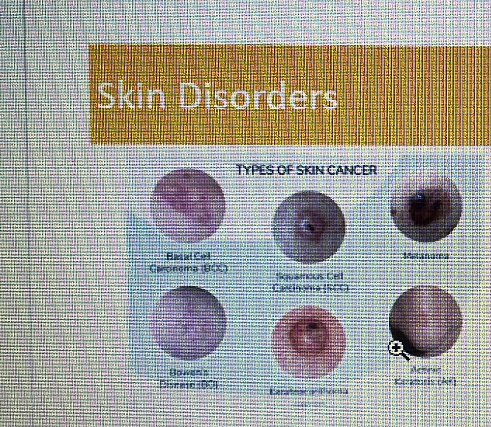 <p>SKIN DISORDER</p><p>Skin cancer</p>