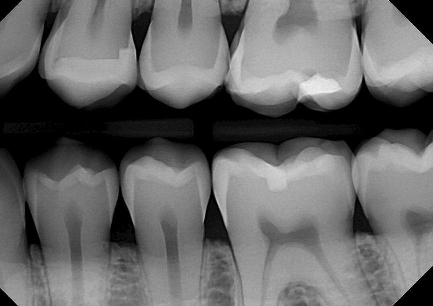 <p>bitewing radiographs</p>