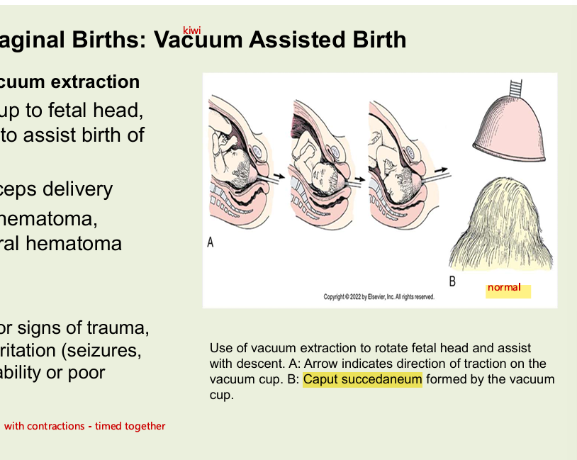 <ul><li><p>vacuum assisted birth or vacuum extraction</p><ul><li><p>attachment of vacuum cup to fetal head using negative pressure to assist birth of head</p></li><li><p>indications - similar to forceps delivery</p></li><li><p>risk to newbron </p><ul><li><p>cephalhematoma, scalp lacerations, subdural hematoma</p></li></ul></li><li><p>nursing care</p><ul><li><p>FHR monitoring</p></li><li><p>newborn assessment for signs of trauma, infection and cerebral irritation (seizures, lethargy, increased irritability or poor feeding)</p></li></ul></li></ul></li></ul><p></p>