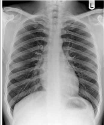 <p>Identify cardiophrenic angle, R + L hemidiaphragms, stomach bubble, liver, spleen </p>