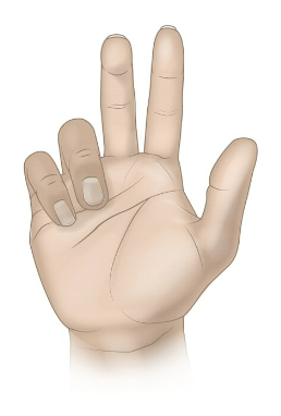<p>hand of benediction (Pope’s Blessing) when the patient tries to make a fist </p>