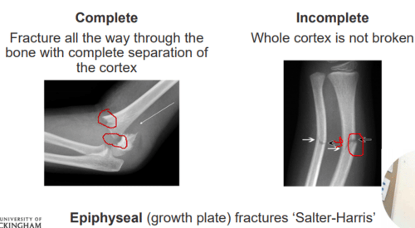 <p>Go through only part of the bone</p><p>Whole cortex is not broken </p>