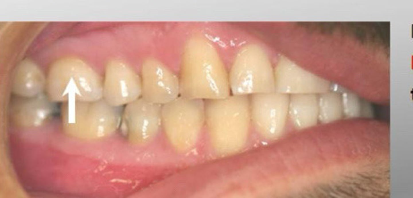<p>Posterior teeth, closest near the teeth</p>