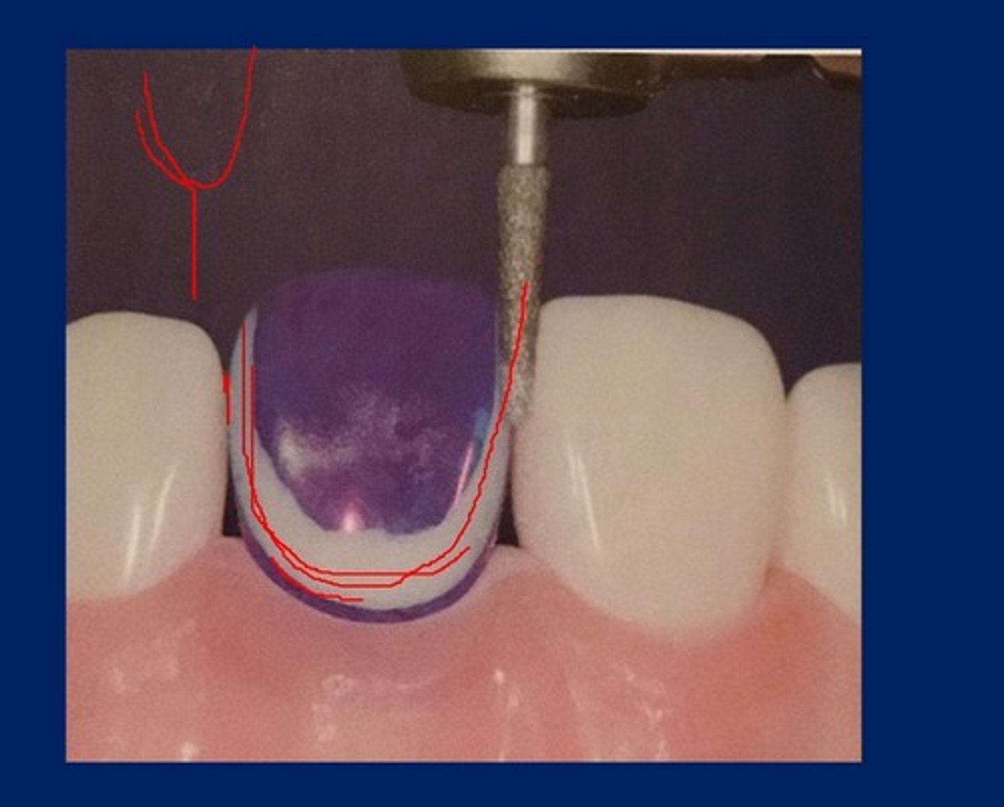 <p>starting with bur as close to adjacent tooth without touching it and going down and then all the way around the tooth to create a cavosurface margin going into the contact point but not breaking it.</p>