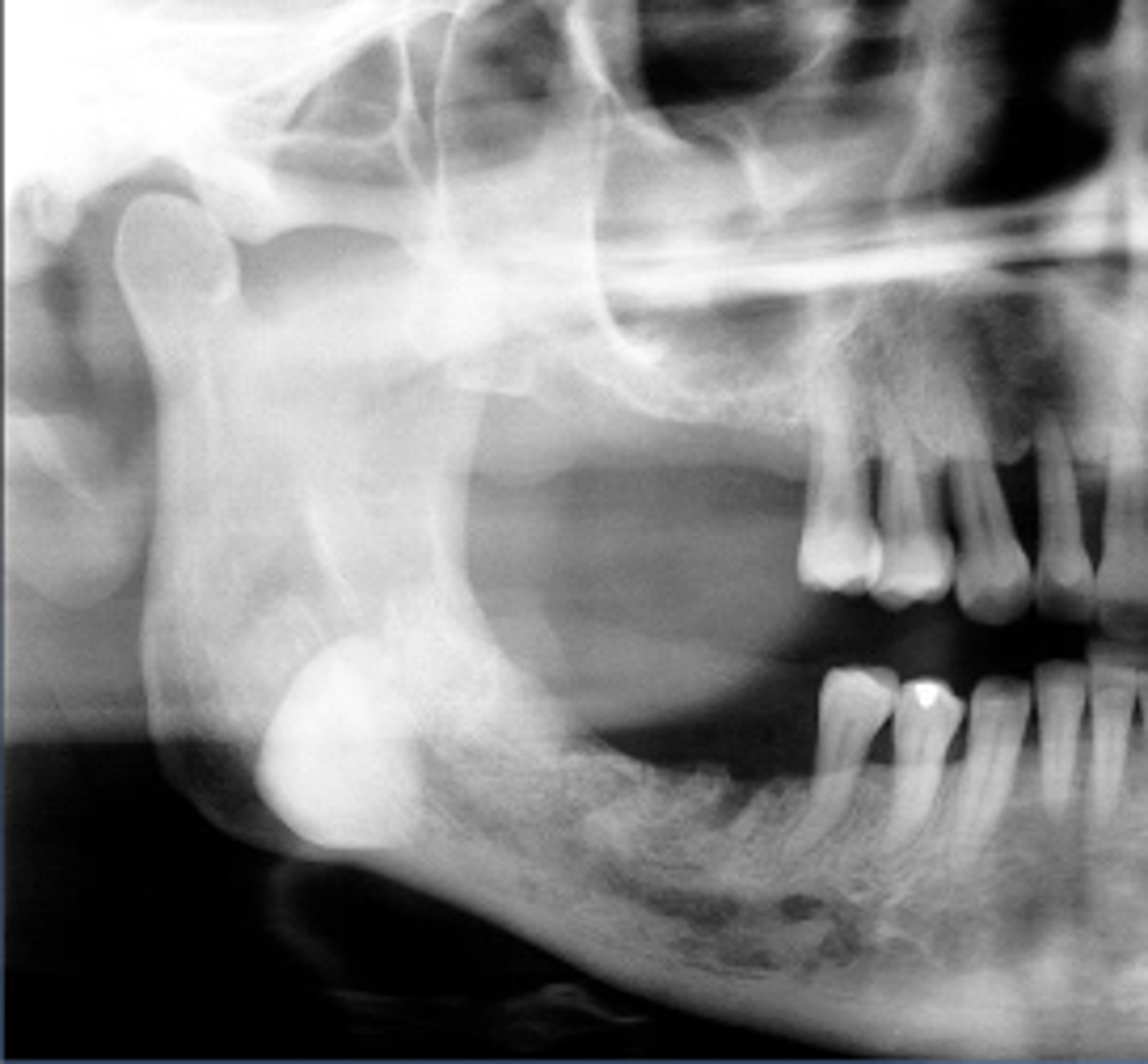 <p>Patient presents with a radiograph that shows a well defined, uniformly radiopaque exophytic mass (the same density as cortical bone), located on the posterior inferior mandible. What is the diagnosis?</p>