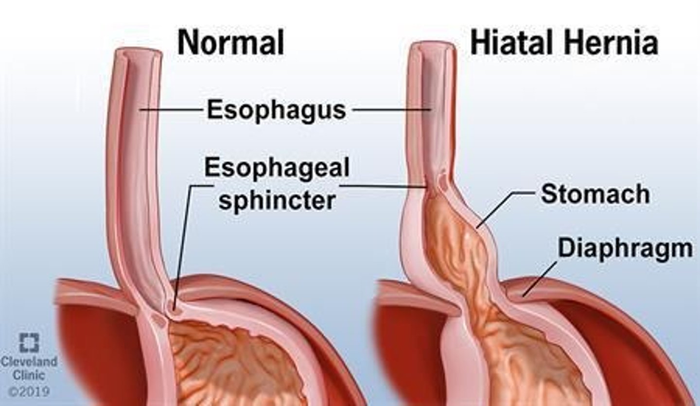 <p>A hiatal hernia occurs when the stomach comes through the diaphragm into the thoracic cavity, causing symptoms such as heartburn or reflux.</p>