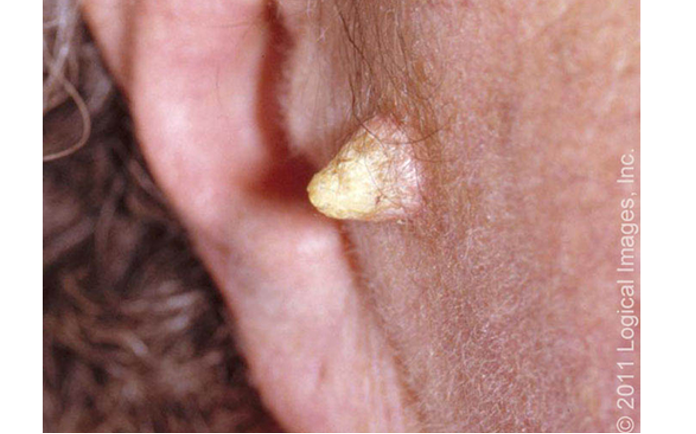 <ul><li><p>appearance of cone or horn w/ papular or radular base and keratitis cap</p></li><li><p>SCC can be present at base</p></li><li><p>other underlying lesions associated: viral warts due to HPV and AKs</p></li></ul><p></p>