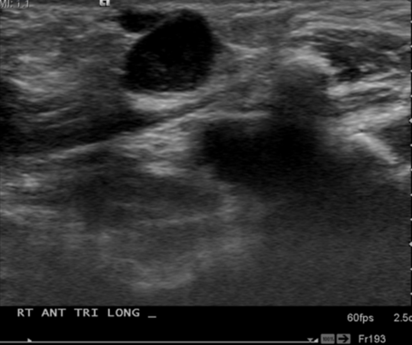 <p>Etiology</p><p>-Congenital diverticulum of the brachial cleft </p><p>Clinical findings</p><p>-Asymptomatic</p><p>-Palpable lateral neck mass</p><p>Sonographic findings</p><p>-Anechoic superficial neck mass</p><p>-Located directly below the angle of the mandible </p><p>-Located anterior to the SCM muscle</p><p>-May demonstrate internal debris </p>