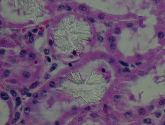 <p>True or False? EG is the only cause of renal oxalates.</p>