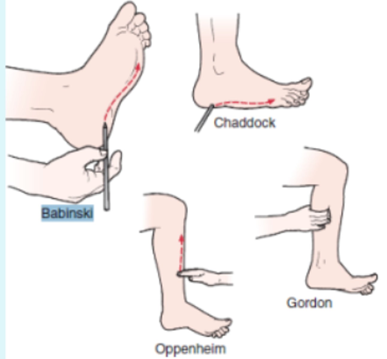 <p>- UMN</p><p>procedure:</p><p>- pointed object along plantar aspect of pt's foot</p><p>(+): extension of big toe and abduction of other toes</p>