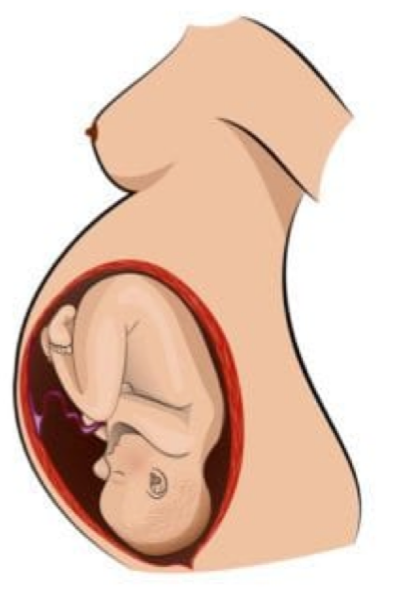<p>Cephalic or breech?</p>