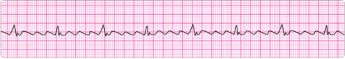 <p>Identify the rhythm.</p>